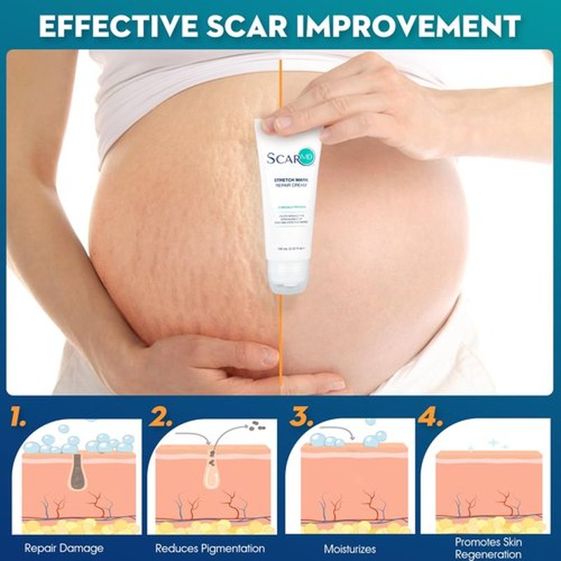 Stretch Mark Repair Cream is Formulated with Botanical Ingredients to Effectively Minimize Stretch Marks for a Smoother, More Even Skin Tone
