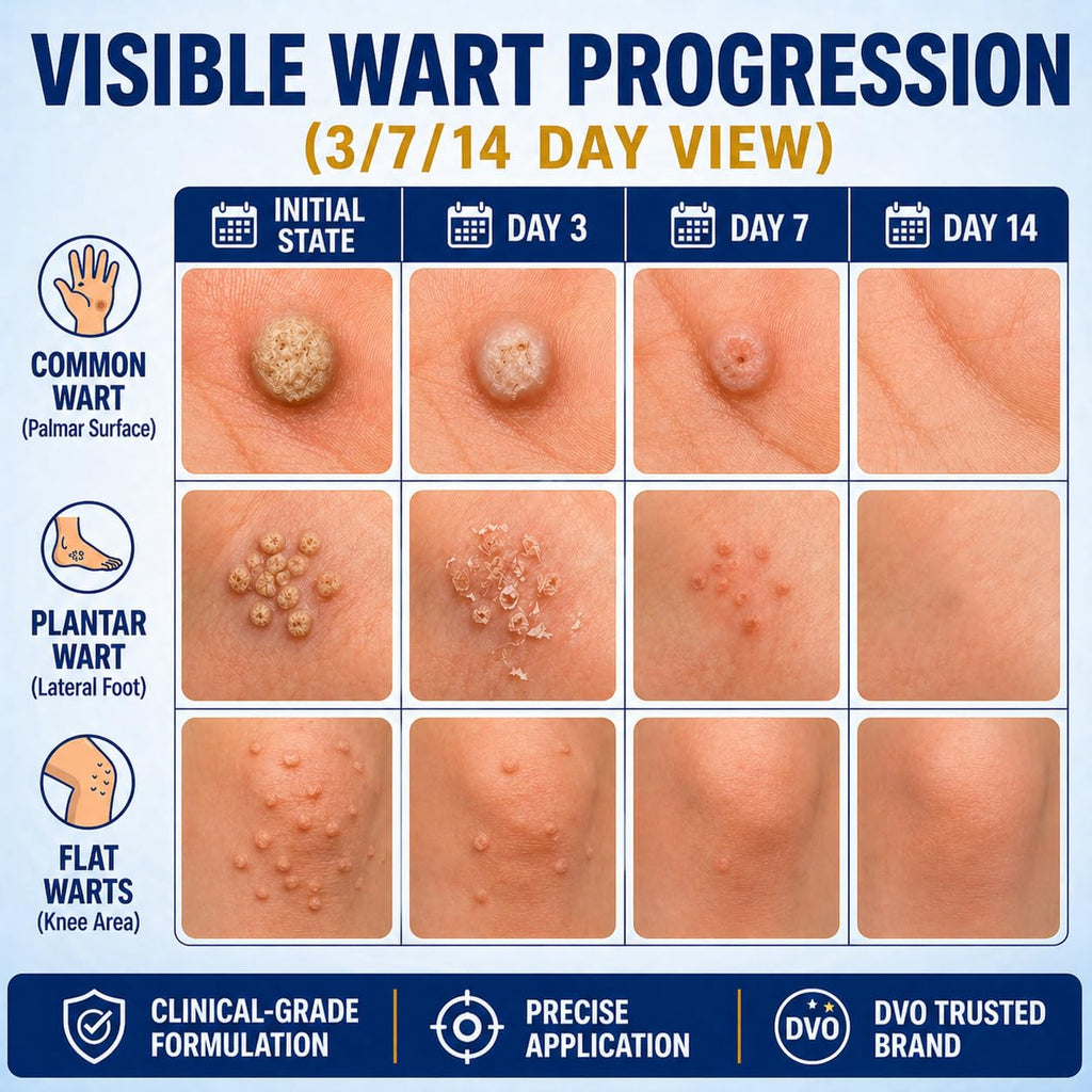 DVO Wart Remover, 20% Salicylic Acid Wart Remover Liquid – Fast Acting Wart Treatment with Precision Brush Applicator, Wart Remover for Hands, Feet & Body 15ml