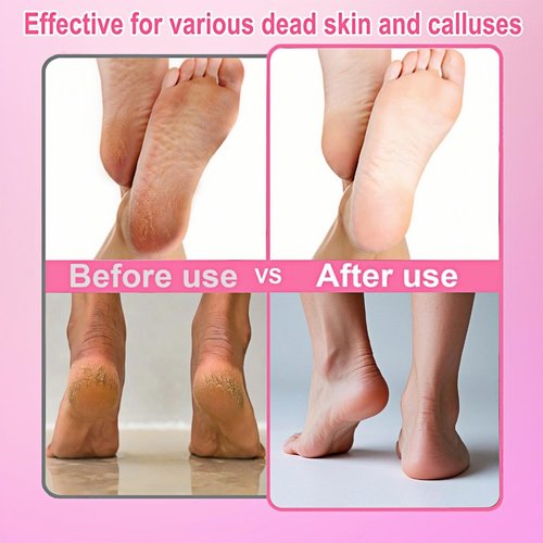 Electric Callus Remover for Dead Skin, Adjustable Speed Pedicure Kit, Painless Foot File with Sandpaper Discs, Mask & 5.9ft Cord, Feet Care for Men & Women(Pink)