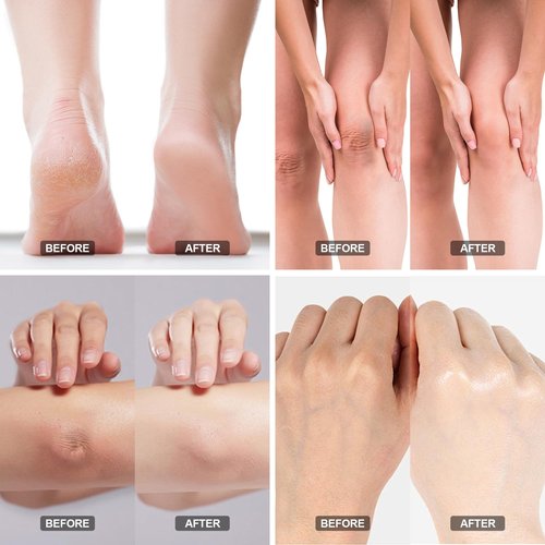 ASDToTio Urea Cream 40% - Foot Care for Dry Cracked Heels, Foot Lotion - With 2% Salicylic Acid, Tea Tree Oil, Shea Butter, Aloe Vera - For Feet, Hands, Heels, Elbows, Knees and More - 6 oz