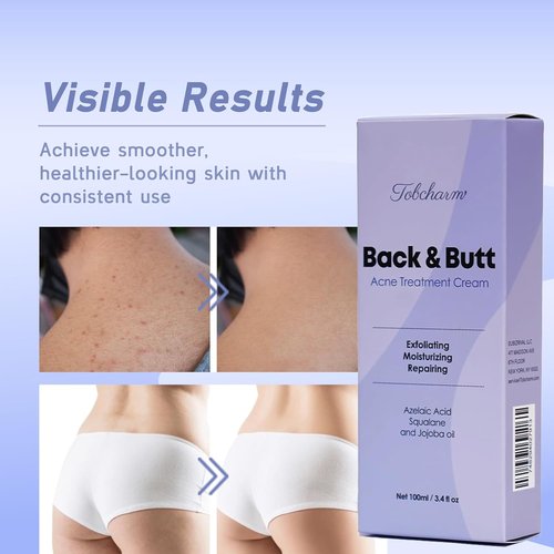 Regine Switzerland Butt Acne Clearing Treatment - Maximum Strength Body Cream for Men & Women | Foaming Cleanser for Bacne & Cystic Acne