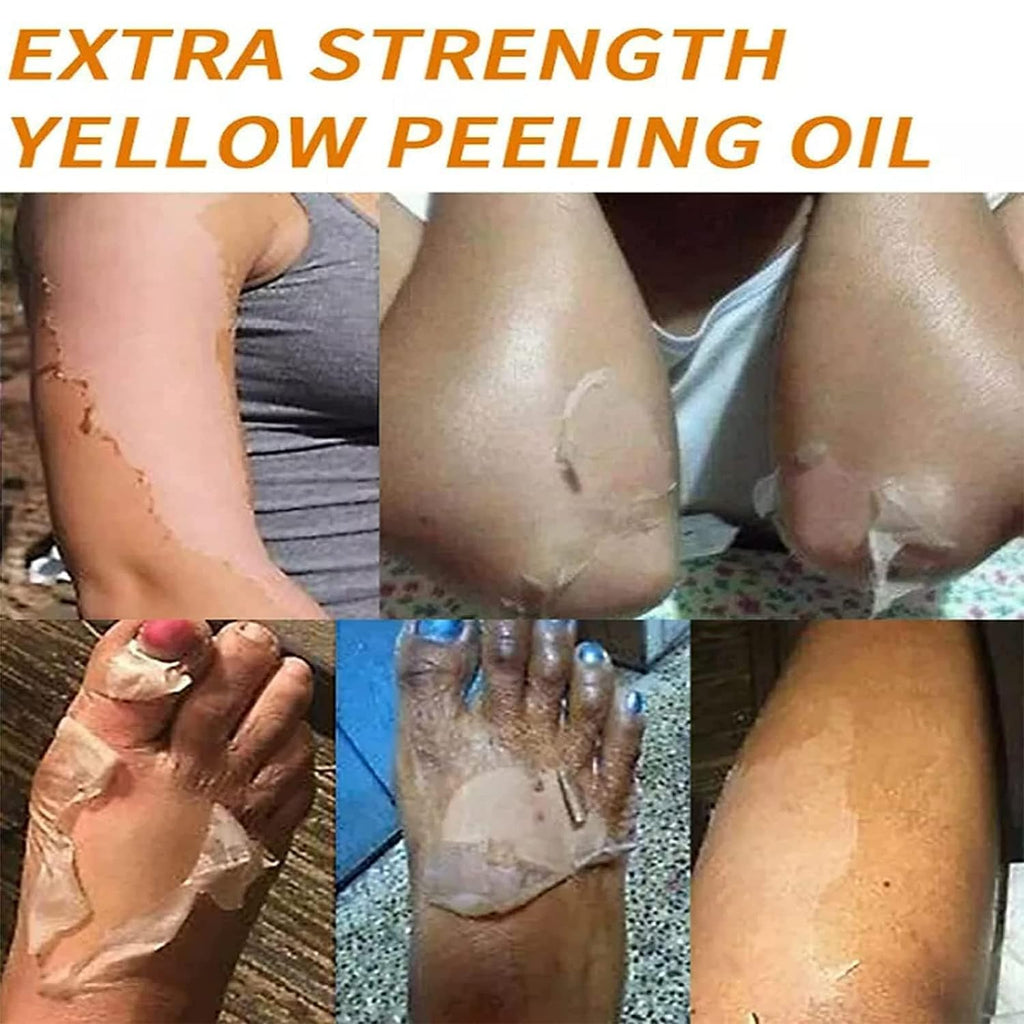 Generic Extra Strong Yellow Peeling Oil for Dark Skin - Exfoliating Solution for Body, Hand, Feet and Face - All Skin Types (110ML/3.88 Fl Oz)