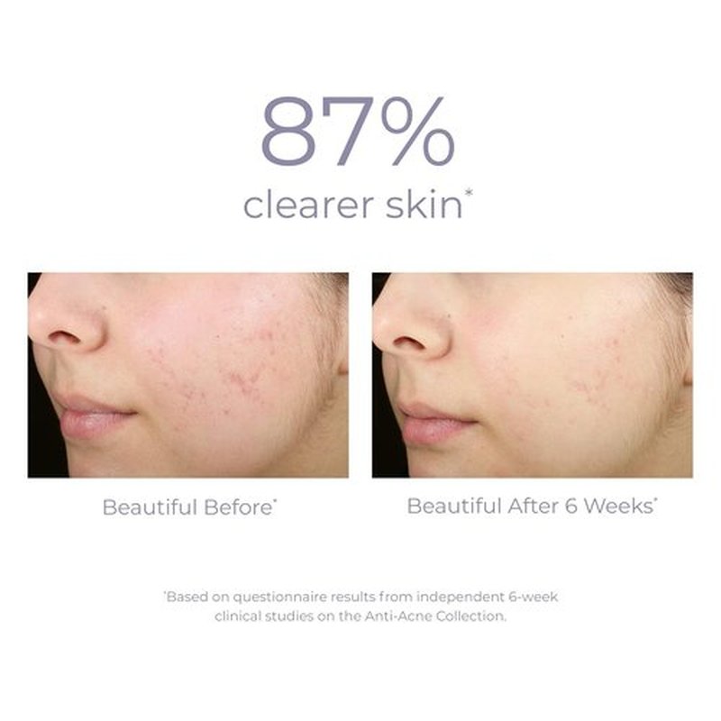 DERMA E Acne Spot Treatment Serum - Clinically Proven Formula for Clearer Skin | 2 Fl Oz