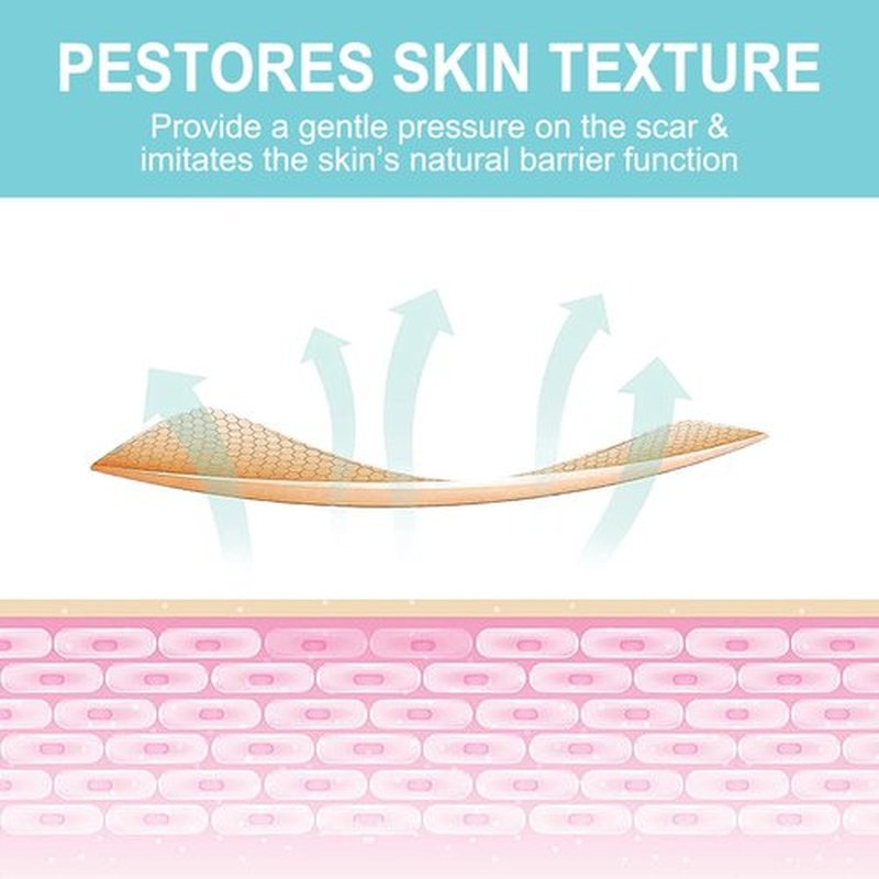 Silicone Scar Sheets (1.6” x 150”-3.8M), Medical Grade Soft Silicone Scar Tape, Scar Strips, Scar Roll - Keloid, C-Section, Surgical, Acne- Scars Removal Treatment, Painless Easy Removal, Reusable