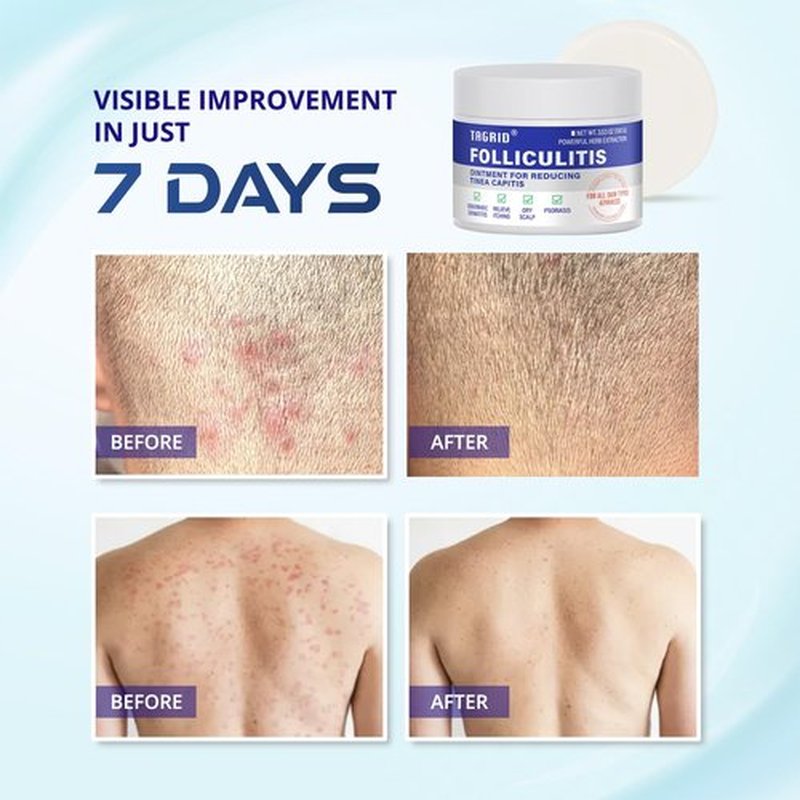 TAGRID Folliculitis Cream, Ingrown Hair, Soothing Scalp, Face & Body Cream - Hydrating & Refreshing - 100g