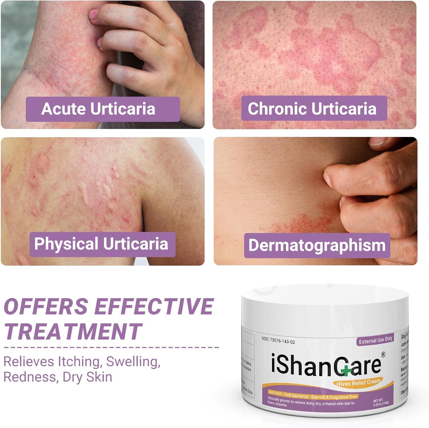ishancare Urticaria Cream, Fast Acting Relief of Hives, Allergic Rashes, Itchy Skin, Redness, Swelling, Anti Fungal Hives Cream with All Natural Herbal Ingredients, 3.53 Oz