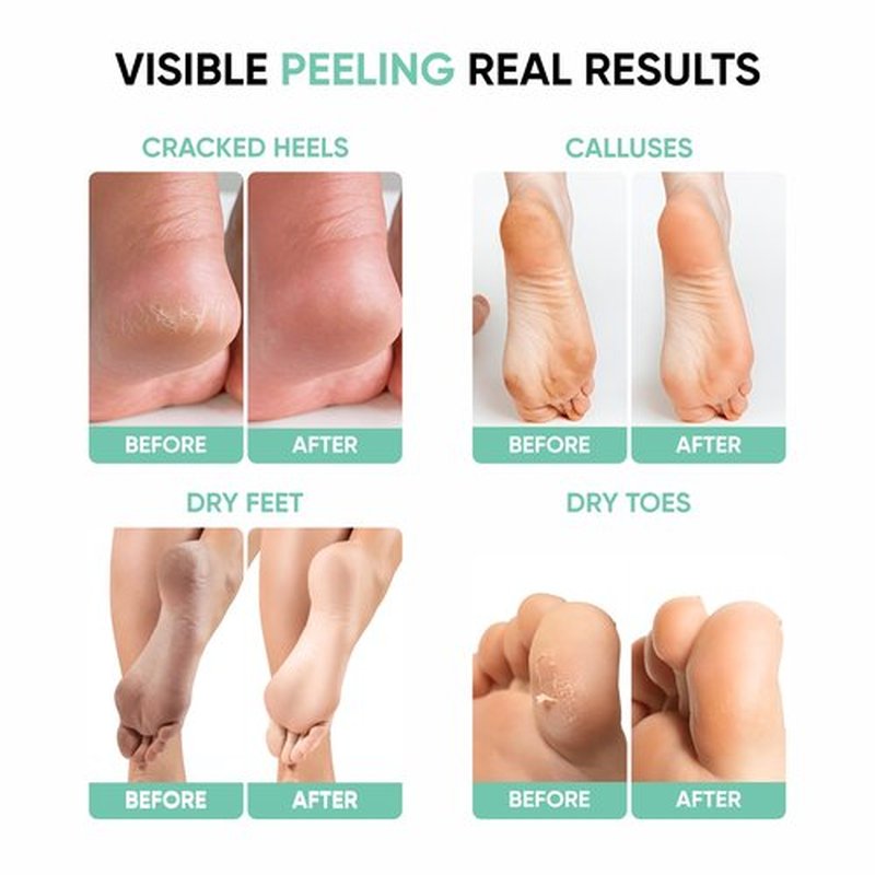 Masofta Exfoliating Foot Peeling Mask for Dry, Cracked Heels & Calluses Glycolic, Lactic & Salicylic Acid Formula Peels Dead Skin in Days Baby Soft Feet Treatment for Men & Women 40 g (Pack of 1)