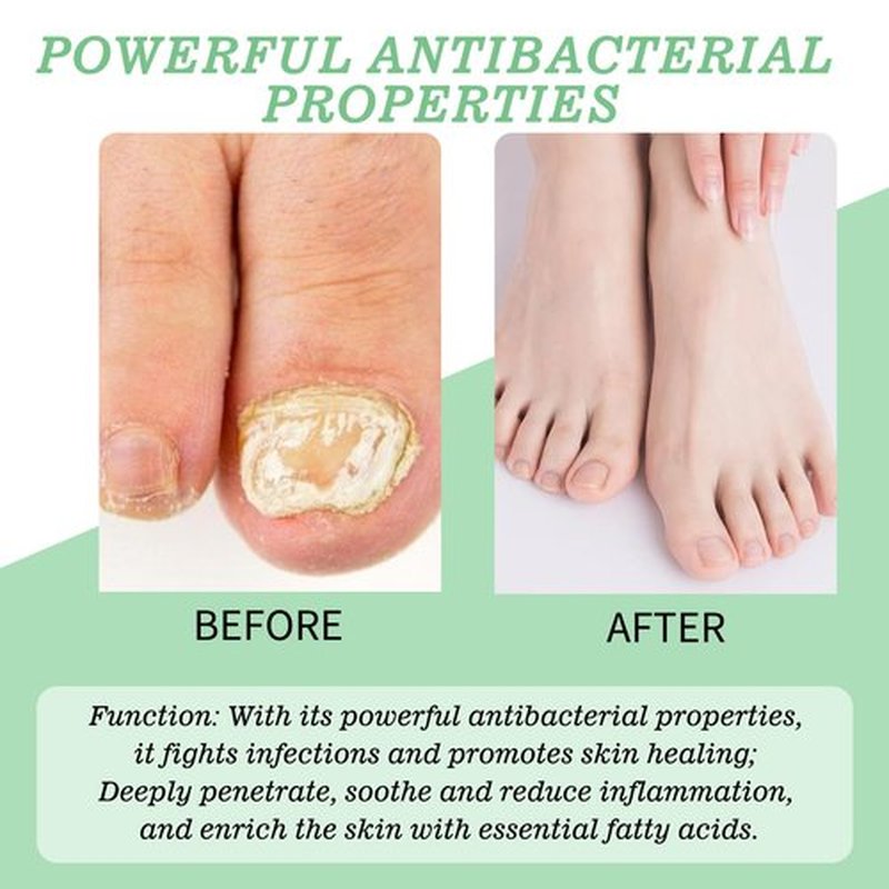 Nutraboost Nail Treatment Gel, Nail Growth Serum for Repair & Strengthener, Multi-Purpose Nail Repair Oil Serum, Foot Care Cream(1pcs)