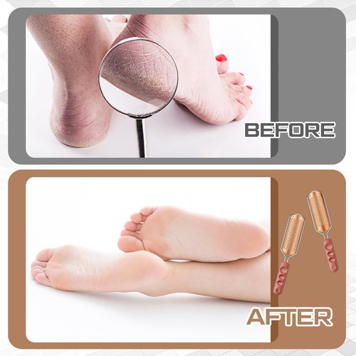 Moxweyeni 14 Pack Colossal Foot File Pedicure Tool Set with 2 Style Large and Small Hole Replacement Callus Remover Blades Rose Gold Stainless Steel Detachable Pedicure Foot Rasp for Dead Skin Remover