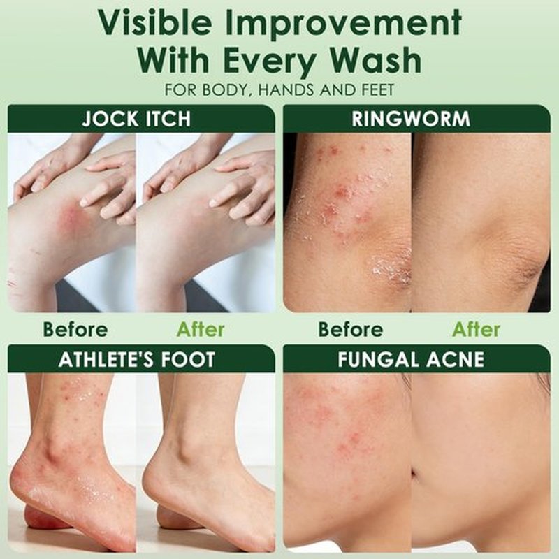Oiangna Antifungal Soap, Tea Tree Antifungal Soap Bar for Back Acne, Athlete's Foot, Tinea, Ringworm, Jock Itch, Face & Body Wash Soothing Care for Men And Women, Relief of Itchy