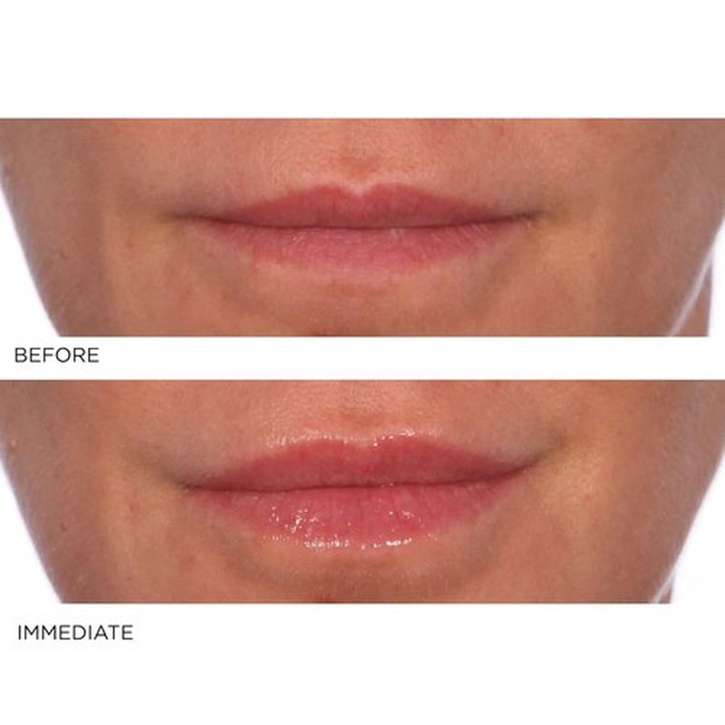 NassifMD Hydro-Screen Lip Plumping Oil - Hydrating Serum with Hyaluronic Acid & Ceramide Jojoba Gloss