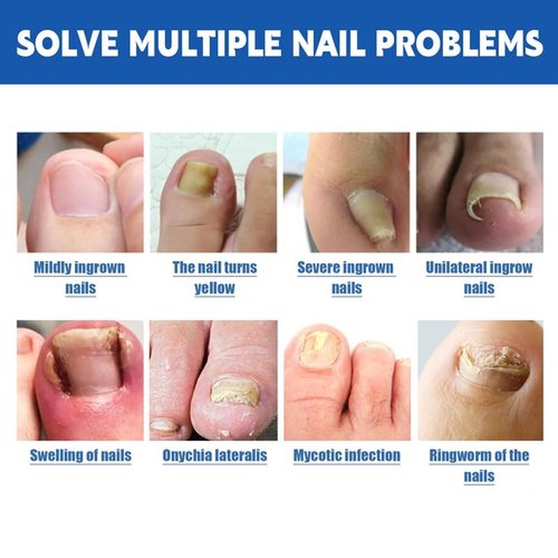 20 Patches Fungal Nail Repair for Toenail Restoration, Treats Thick, Damaged, Discolored or Falling Off Toenails, 8-Hour Intensive Treatment, Includes Nail Care Bandages