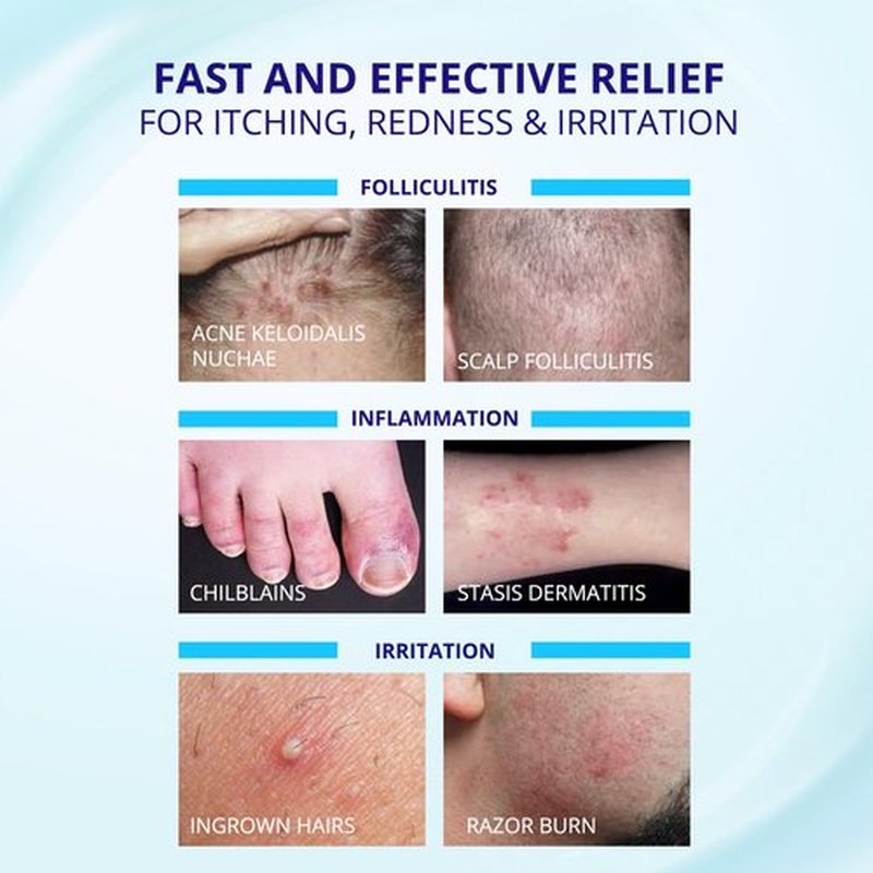TAGRID Folliculitis Cream, Ingrown Hair, Soothing Scalp, Face & Body Cream - Hydrating & Refreshing - 100g