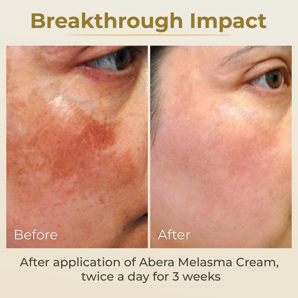 ABERA Melasma Cream, Dark Spot Corrector - Melasma, Freckle, Sun Spot, Age Spot Remover Advanced Formula for Women and Men (3 Boxes)