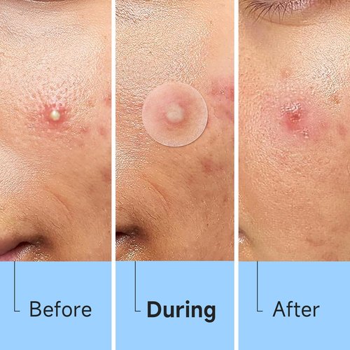Glowpatch Acne Pimple Patch(840 Counts 4 Sizes), Zit Stickers for Face, Hydrocolloid Spot Stickers, Clear Acne Dots for Covering Zits, Blemishes, and Breakouts