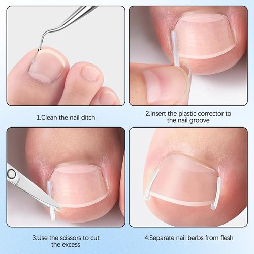 Ingrown Toenail Corrector Set with Correction Strips, Professional ingrown toenails pedicure tool set for men and women (1 SET)