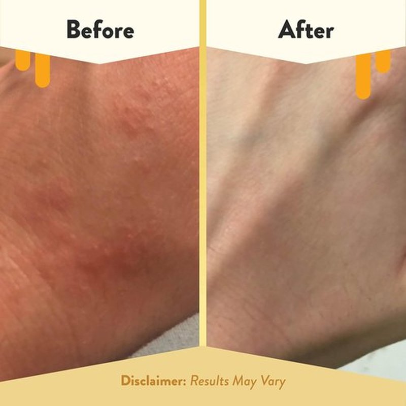 Regine Switzerland Eczema Honey Oatmeal Body Lotion - Natural Relief for Dry Skin (16 Oz)