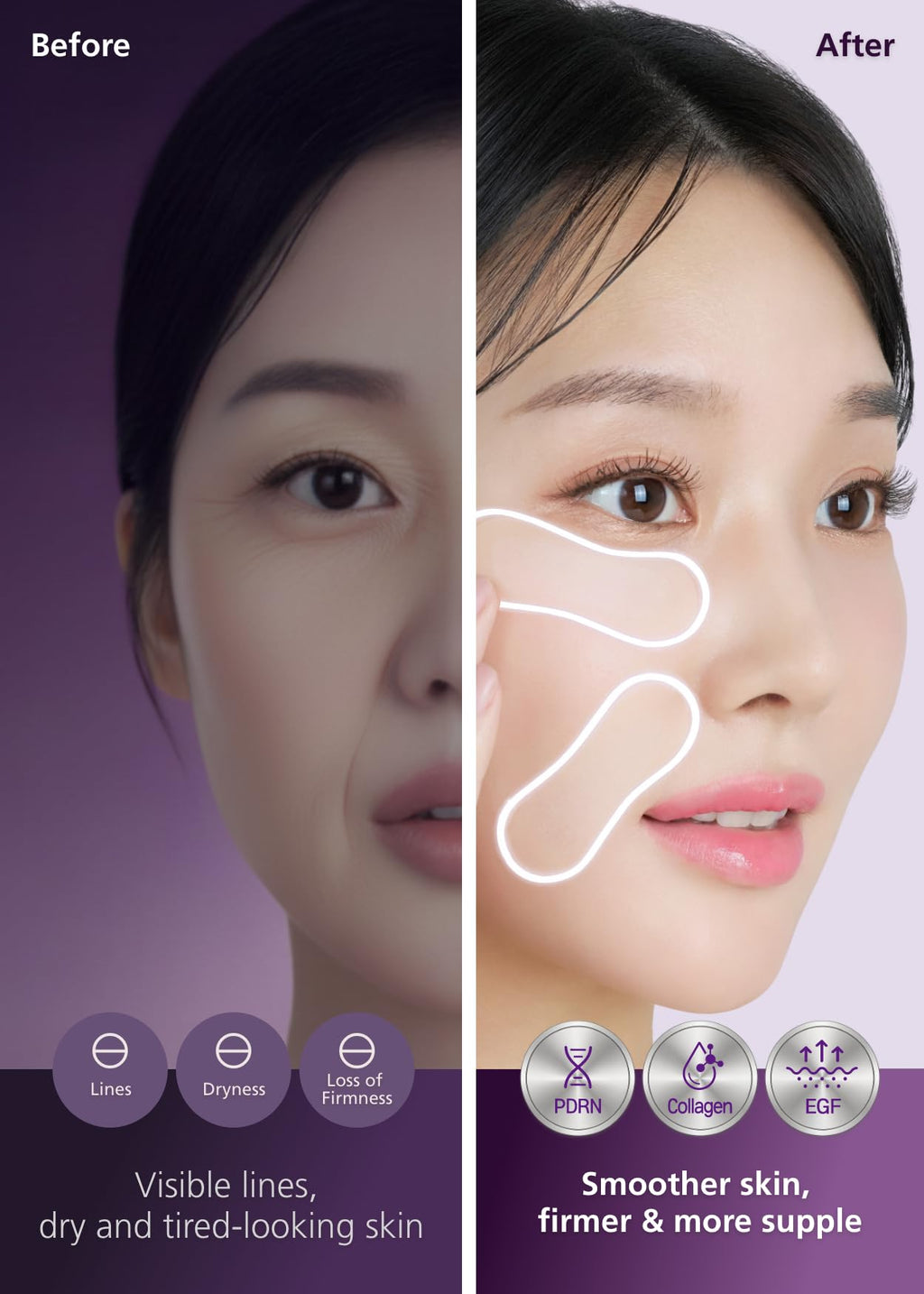 DWEasyDerm Easyderm PDRN Anti-Wrinkle Patch - Under Eye & Smile Line treatment, 8 Patches, K-Beauty Korean Skincare with Collagen & EGF, Eye patches, PDRN Eye Mask, Summer & Travel Essentials