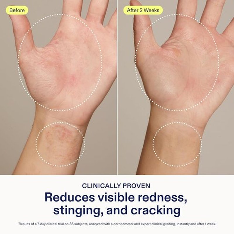 Skinfix Hand Relief Cream - 3 Fl Oz - Soothes Redness & Cracking for Dry, Sensitive Skin - Eczema Approved - Fragrance-Free, Vegan