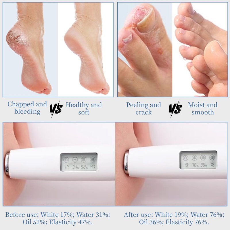 YOUNGYOUNGLOVE 10.1 Oz - Urea Cream 70% plus Salicylic Acid 2% for Dry Cracked Feet, Heels, Knees, Elbows and Hands, Moisturizes, Softens and Removes Calluses Dead Skin (10.1 oz, 70%)