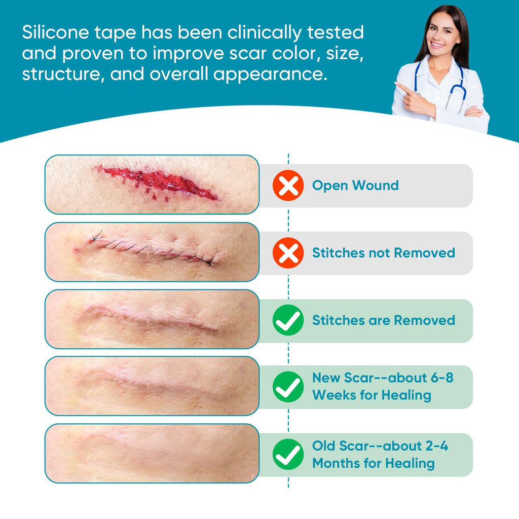 VPRIME SAFETYFY Silicone Scar Tape, Silicone Scar Sheets for Surgical Scars (1.6"x 80" Roll-2M), Medical Ggrade Scar Tape for Scars, Keloid, Acne Scars, Burn, C-Section, Stretch Marks Scars Away