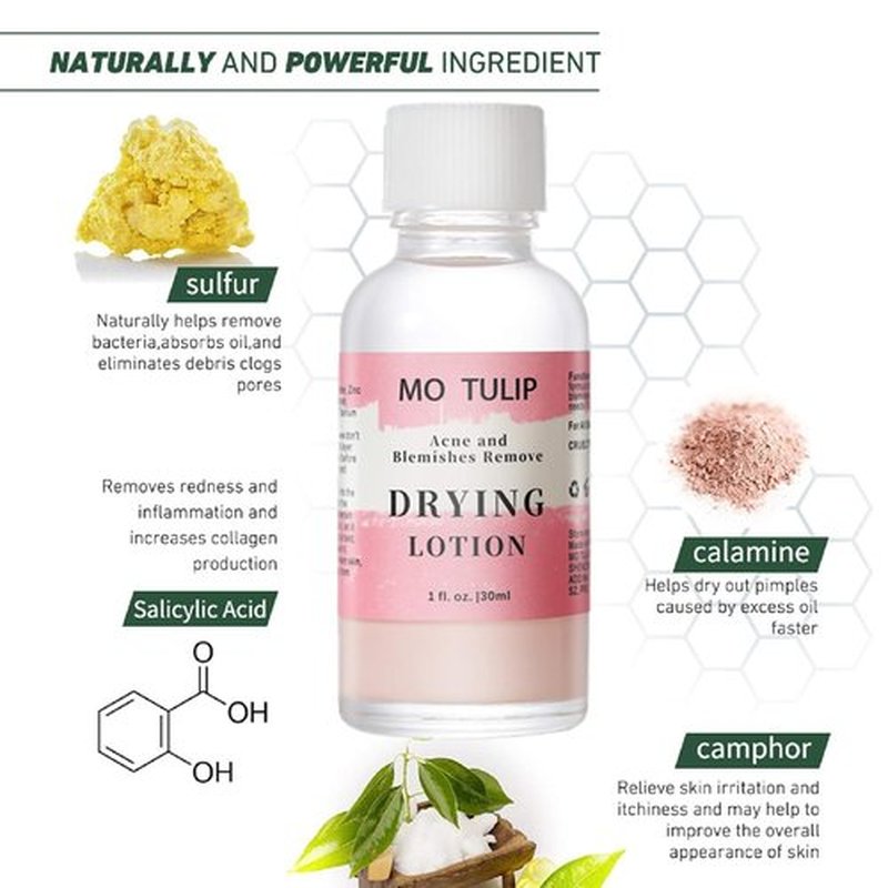 MO TULIP Acne Drying Lotion - Overnight Spot Treatment for Face & Body | 1 OZ Pimple Solution