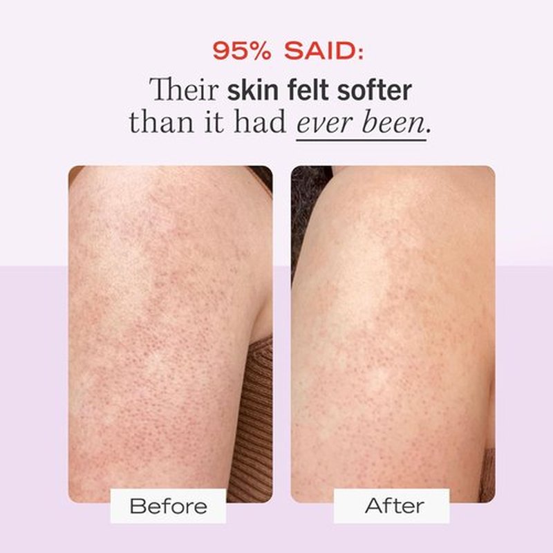 KP Bump Eraser Body Scrub & Ingrown Hair Pads Duo - Exfoliating Treatment for Keratosis Pilaris | 10 oz Scrub, 60 Pads