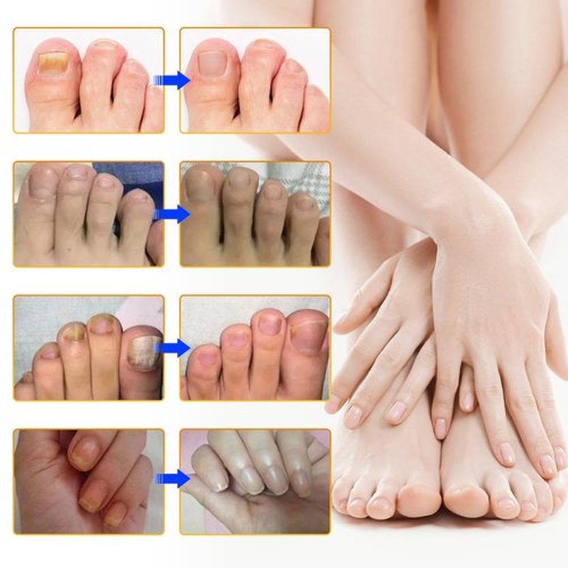 Toenail Treatment Extra Strength-8-Hrs Overnight Nail Repair,ingrown toenail treatment,Strengthens Brittle Nails,Improves Texture & Thickening Hypoallergenic Easy (64 Patch)