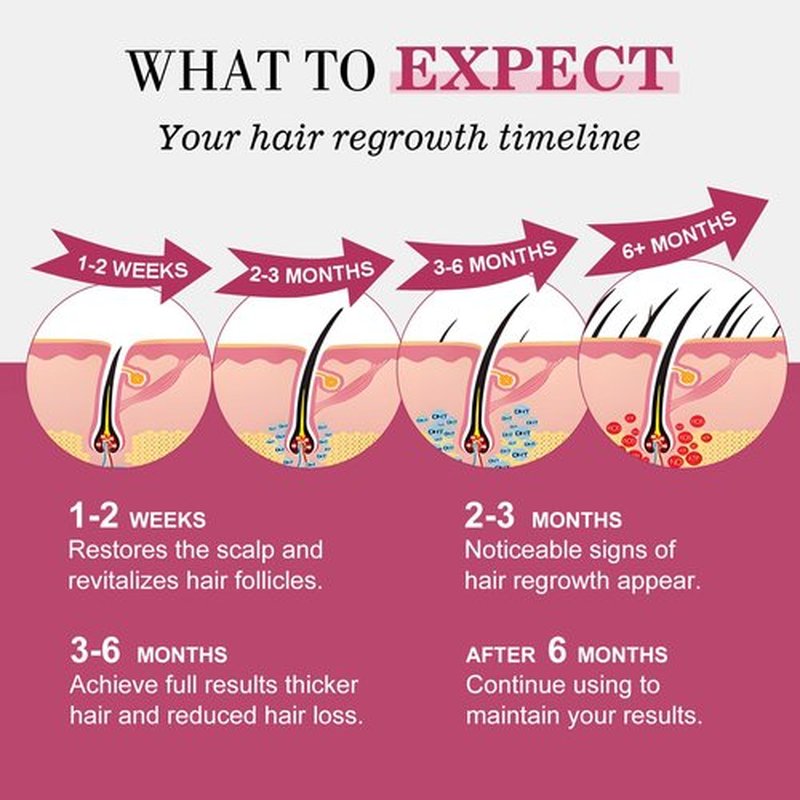 5% Minoxidil for Women Hair Regrowth Spray, hers hair regrowth treatment Infused with Biotin, Extra Strength Treatment to Combat Hair Loss and Thinning, 6 Bottles（100 Ml)