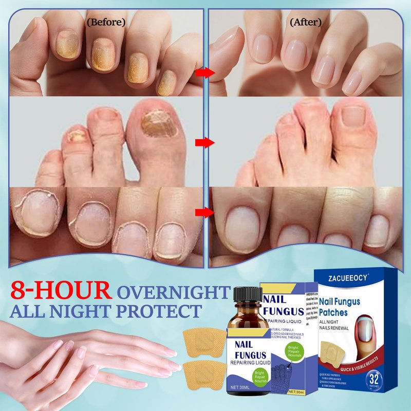 ZACUEEOCY Toenail Fungus Treatment Extra Strength Kit, 30ml Nail Repair Solution and 32 Nail Renewal Patches for Damaged Thick Discolored Toenails and Fingernail