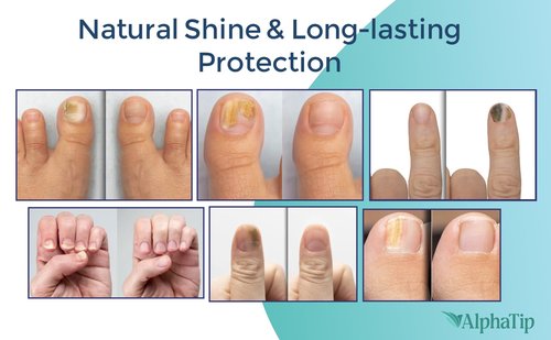 Toenail Treatment & Nail Repair Pen, Nail Strengthener and Care Solution for Damaged, Brittle Nails – Gentle Botanical Formula, Easy Twist Pen – 2 Packs × 2 (4 Pens Total)