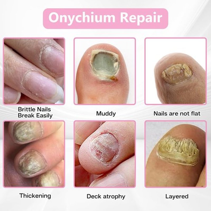 Nail Patches - Toenail Care for Toenail Fingernails - 8-Hour Nightime N ail Renewal - 30