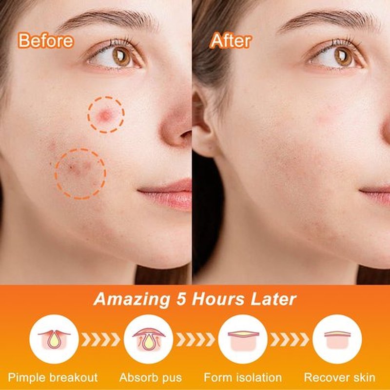 CELECARE,Pimple Patches,Halloween Acne Patch,Pimple Patches for Face, Cute Stickers,Salicylic Acid & Tea Tree, 100PCS Hydrocolloid Dots in 8 Colors for Face,Cute Halloween Stickers