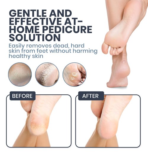 SoleLux Upgraded 2025 Electric Foot File – Callus Remover for Women & Men with Adjustable Speed, 60 Sanding Pads & Dead Skin Exfoliation – at-Home Pedicure Tool for Dry, Cracked Feet(Black)