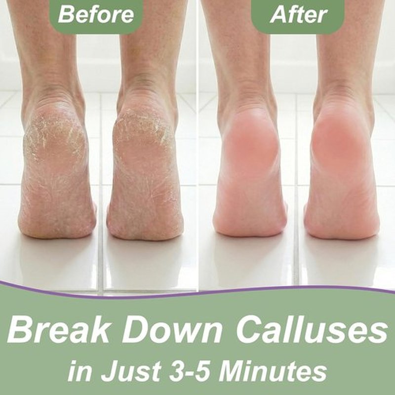 Skiennix Callus Remover Gel - Extra Strength 8 oz Foot Care with Double-Sided File & Spa Kit