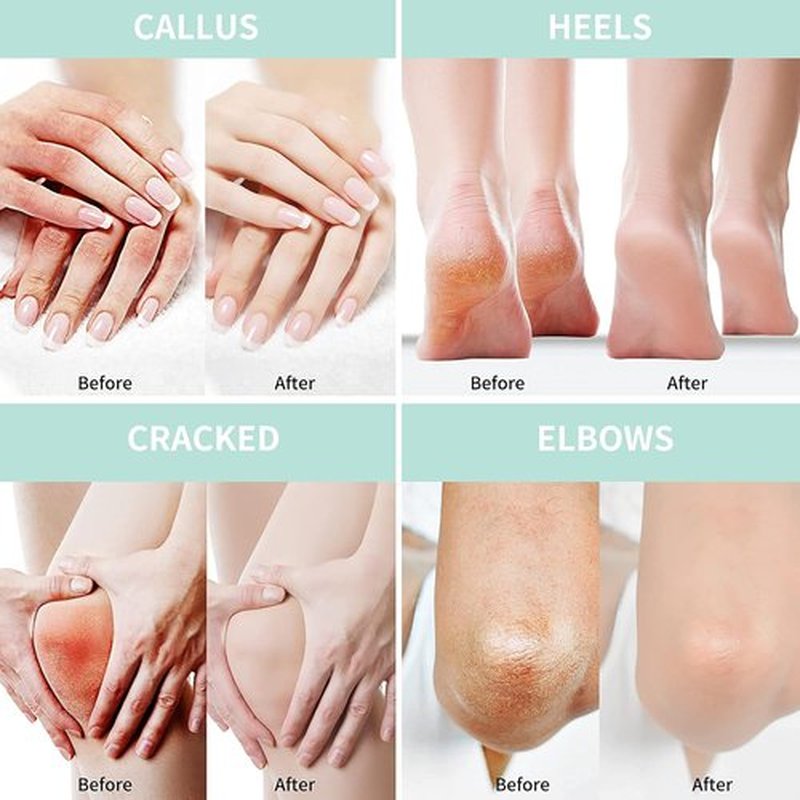 Grocerism Urea Cream 40% - Maximum Strength Foot & Hand Cream with Salicylic Acid, 5.29 oz | Deep Moisturizing Formula with Hyaluronic Acid, Tea Tree & Aloe Vera