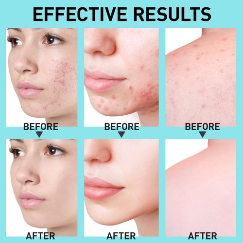 Salicylic Acid Acne Spot Treatment: Cystic Hormonal Pimple Cream for Stubborn Zits, Blemish Breakout & Post-Acne Scars - Face, Body & Back, Teens-Adults, 1.8 oz