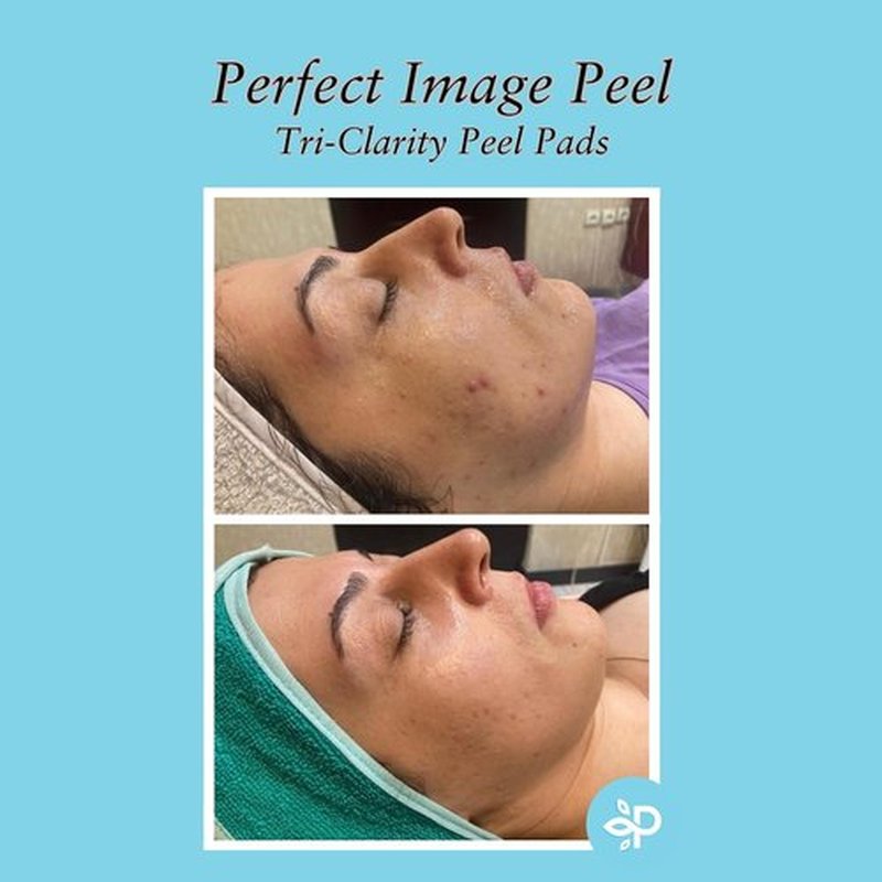 Tri-Clarity | Peel Pads with Salicylic Acid & Tea Tree Oil - 25% Strength for Clearer Skin