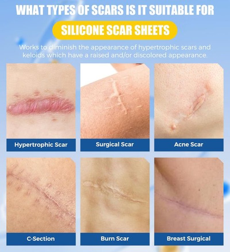 MasterMo Medical Grade Silicone Scar Sheets & Tape - 1.6”x120“ Roll, Ultra Soft, Hypoallergenic Rolls for Surgical, C-Section, Tummy Tuck, Keloid Scars, Stretch Marks & Burn Scar Removal