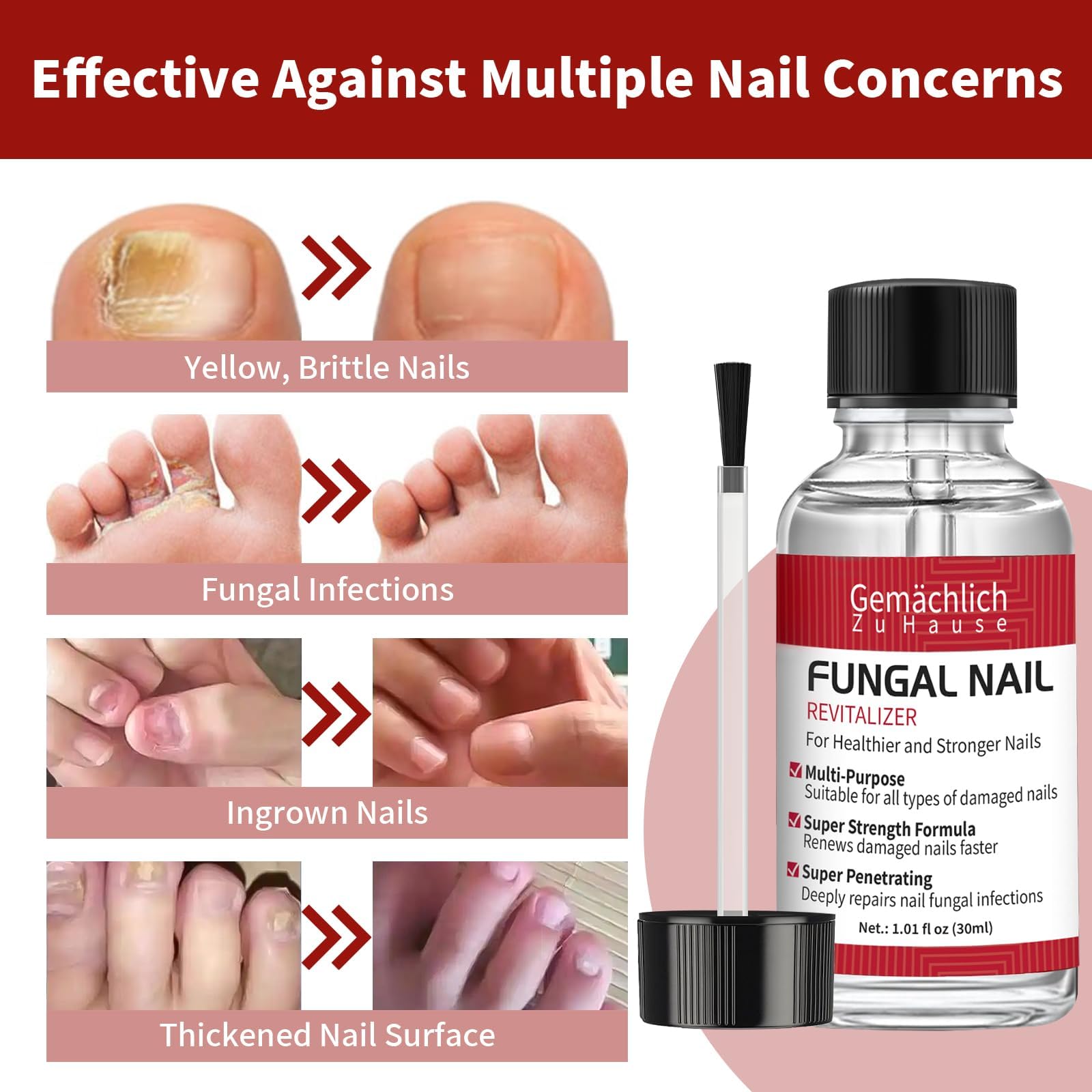 Toenail Fungus Treatment Extra Strength, Nail Fungus Treatment with Undecylenic Acid for Toenail & Fingernails, Antifungal Nail Repair for Athletes Foot, Ingrown, Thick, Broken, Damaged Nail, 30ml