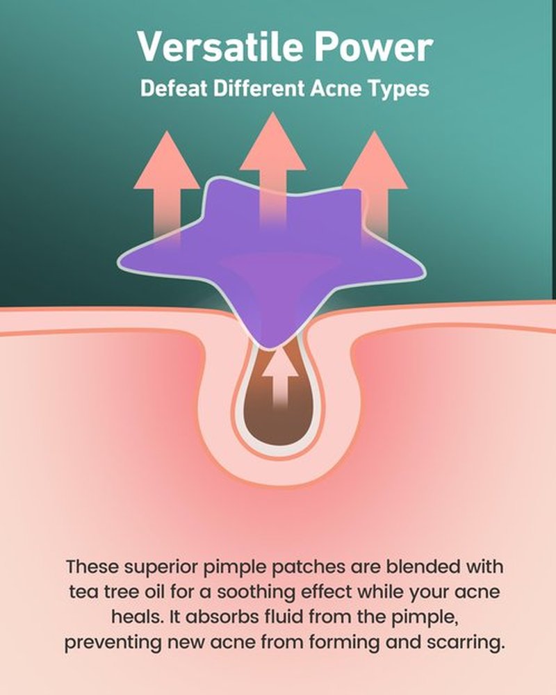 Jefusst Star Acne Pimple Patch 140 Counts, Hydrocolloid Acne Patches for Face, Purple, Blue, Green, Pink and Yellow