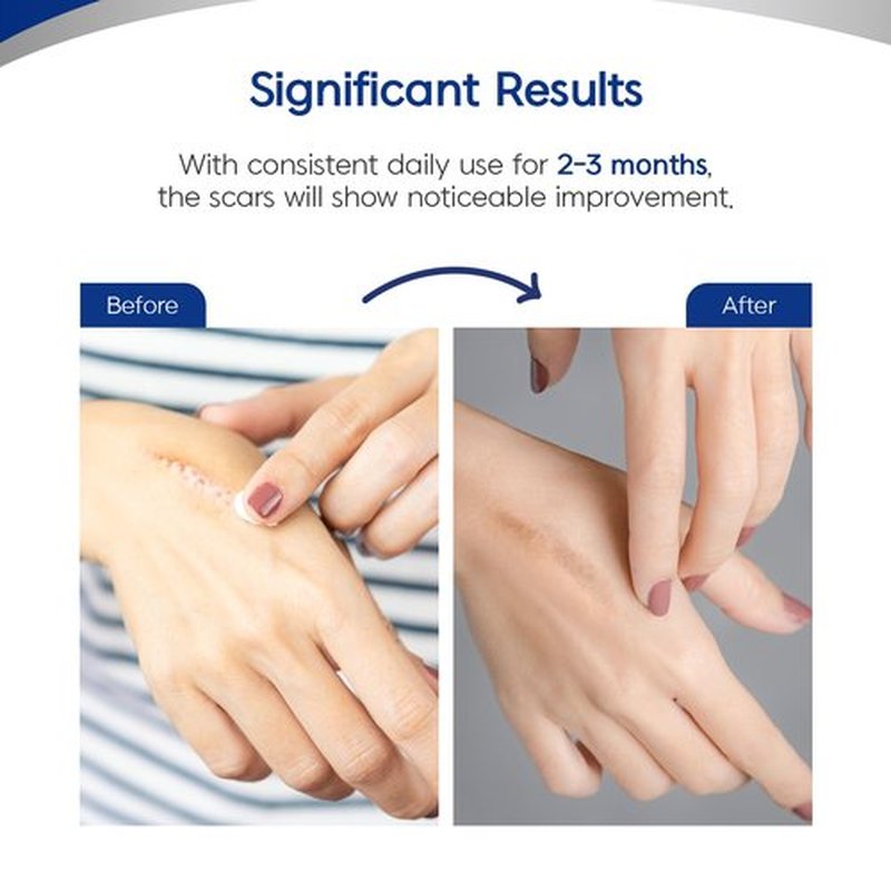 MURASAKI BEAUTY Silicone Scar Tape & Sheets – Removal on Keloids, Burns, Abrasion, C-Section, And Surgical Scars – Safe For Adults And Children – 1.6"X 60" Roll-4 X 1.5M(Pack of 1) (1.6X60inch)