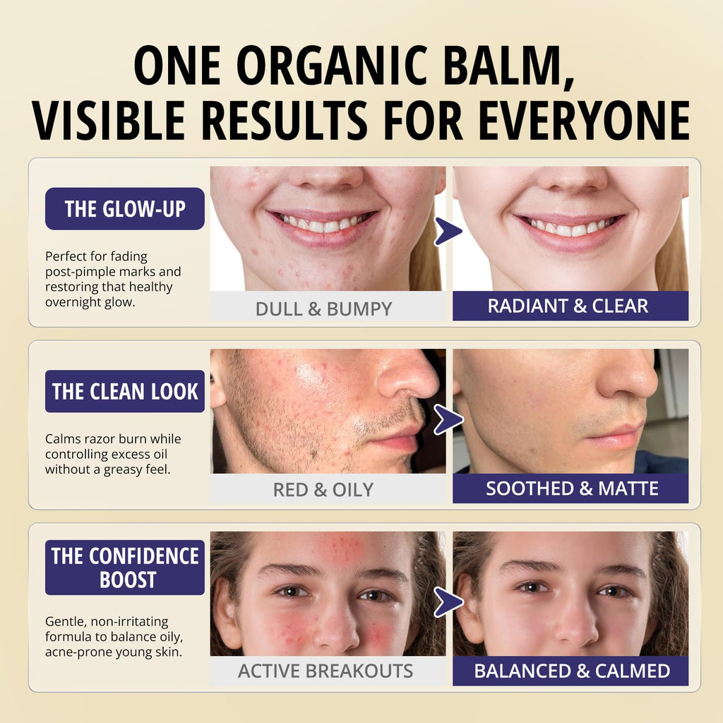 Bealions Organics Acne Killer Night Balm, 30g