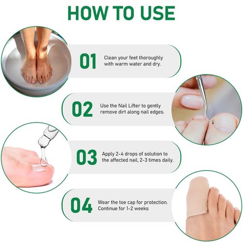 Ingrown Toenail Treatment: Ingrown Toenail Removal Kit - Ingrown Toenail Tool for Men Women - Ingrown Toenail Corrector Drops - Ingrown Toenail Remover - Effective Solution for Ingrown Toenails - 30ml