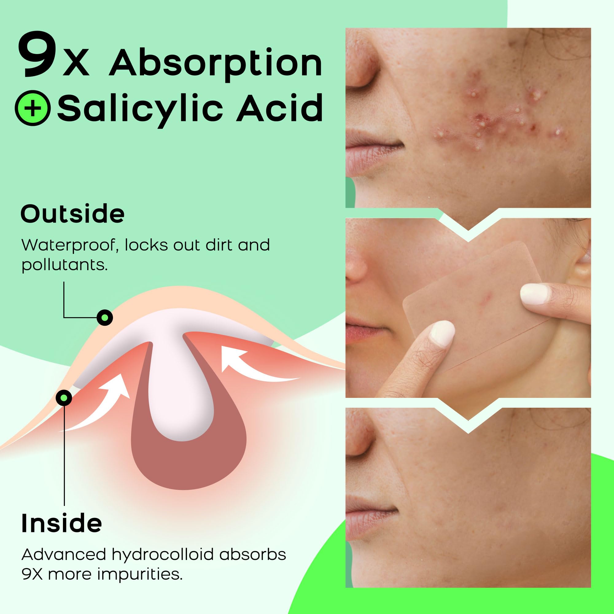 AVAPY XL Hydrocolloid Acne Patches - Extra Large Pimple Patches for Cystic Acne on Face & Body | Nose, Chin, Back & Bacne Treatment | Vegan & Cruelty-Free (8 Count)
