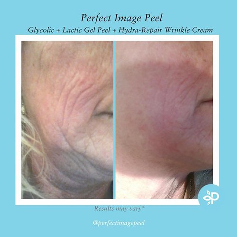 Glycolic Gel Peel by Regine Switzerland - 10% Strength with Retinol & Green Tea Extract