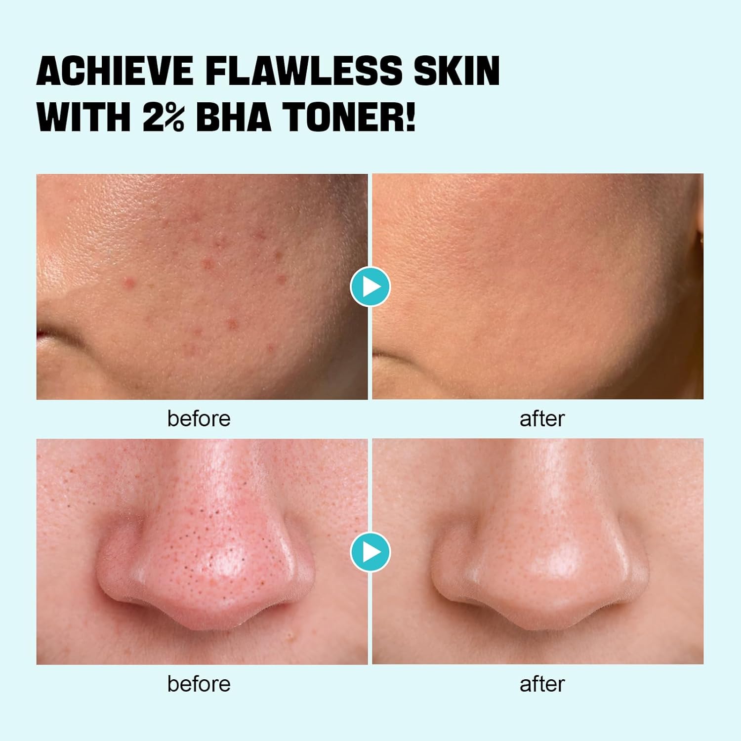ZealSea Salicylic Acid Toner - Blackhead Remover & Pore Minimizer | Gentle Alcohol-Free BHA, 6.76 oz