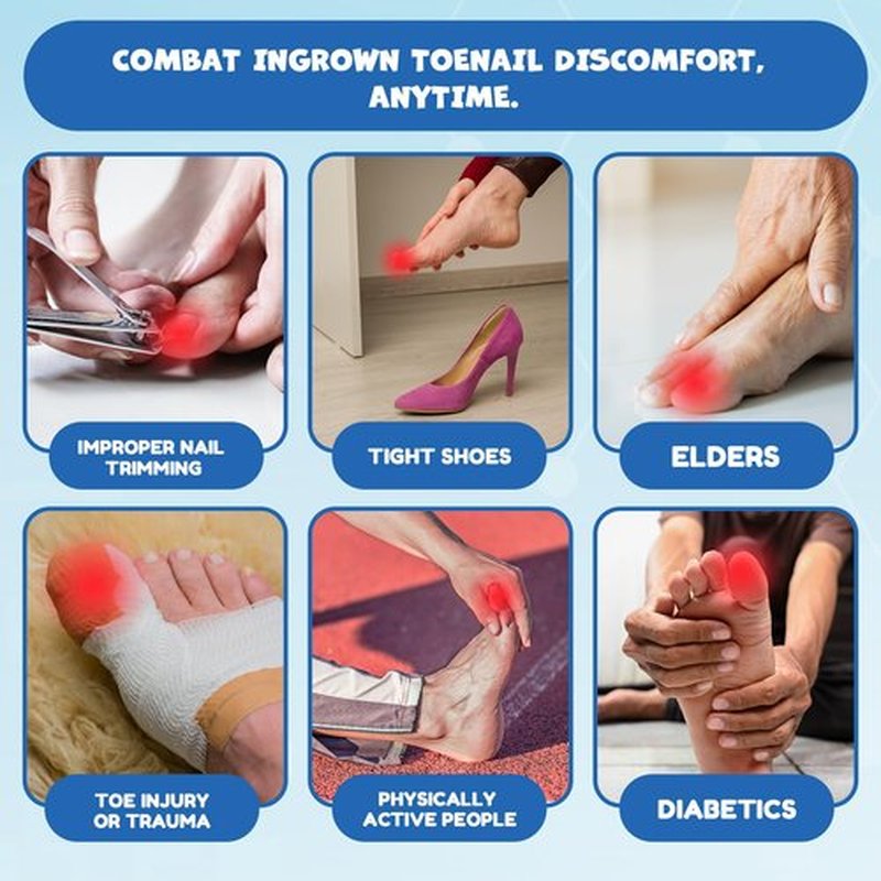 Ingrown Toenail Corrector Kit - Professional Home Pedicure Care for Toenail - Includes Toenail Correction Strips for Ingrown Toenail Relief Removal