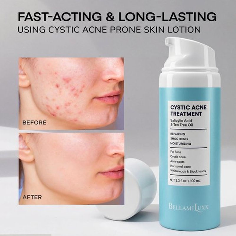 BellamiLuxx Cystic Acne Treatment for Face: Hormonal Acne Treatment Cream for Teens & Adults - Salicylic Acid & Tea Tree Oil Pimple Spot Remover - Anti-Acne Moisturizer Reduces Redness, Blemishes