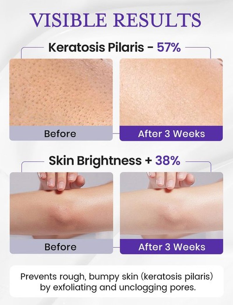 Elvira KP Bump Eraser Foot & Body Scrub, Exfoliating Scrub for Keratosis Pilaris, Smooth Skin with 10% AHA BHA & Niacinamide, Deep Moisturizing Cleanser for All Skin Types, Exfoliante para el Cuerpo